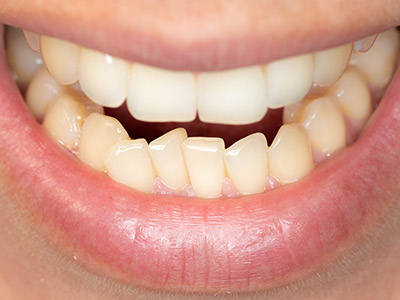 A close-up of a smile showing lower teeth with noticeable dental crowding.