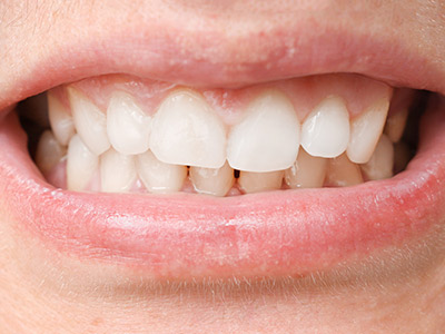 A close-up image of a closed-mouth smile showing misaligned and crowded teeth.