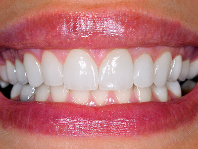A close-up of a smile with protruding upper front teeth and glossy lips.