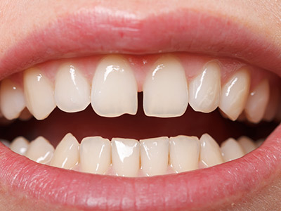 Close-up of a smile showing teeth with noticeable gaps indicating spacing issues.