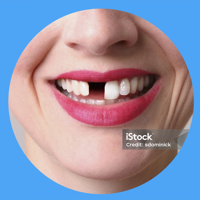 https://www.adelaidebraces.com.au/wp-content/uploads/2024/02/missing-teeth-bnr.jpg