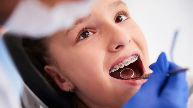 Straightening Smiles: How Braces Can Correct Overbites in Kids
