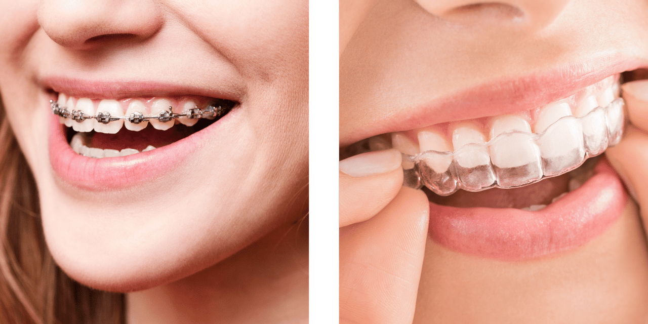 Braces vs. Invisalign: Which is Right for You?