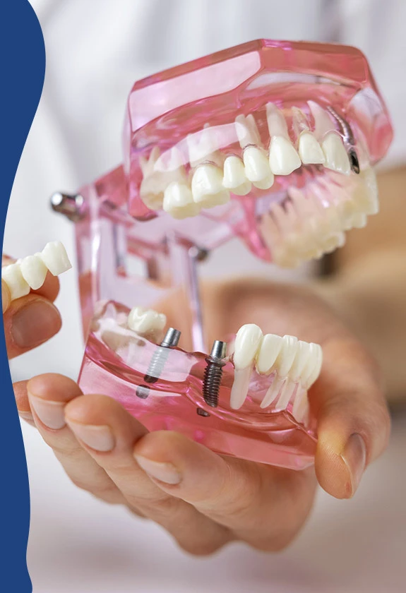 Dental bridges benefits