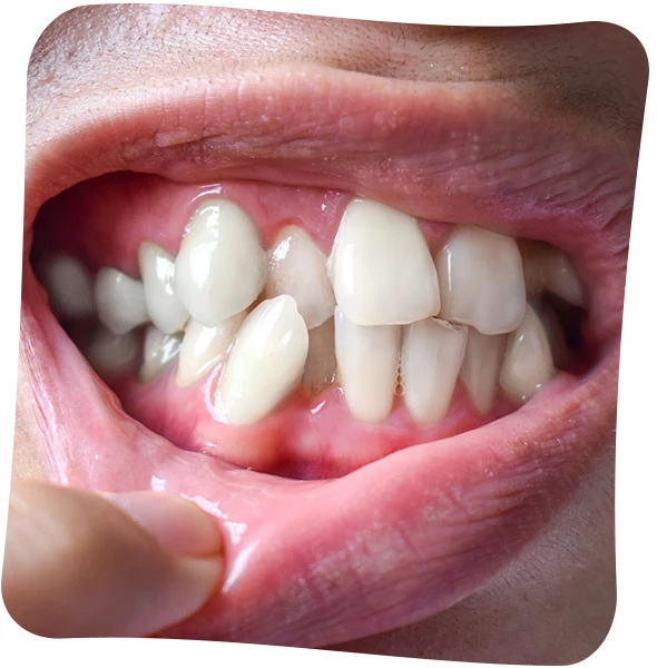 crooked teeth treatment