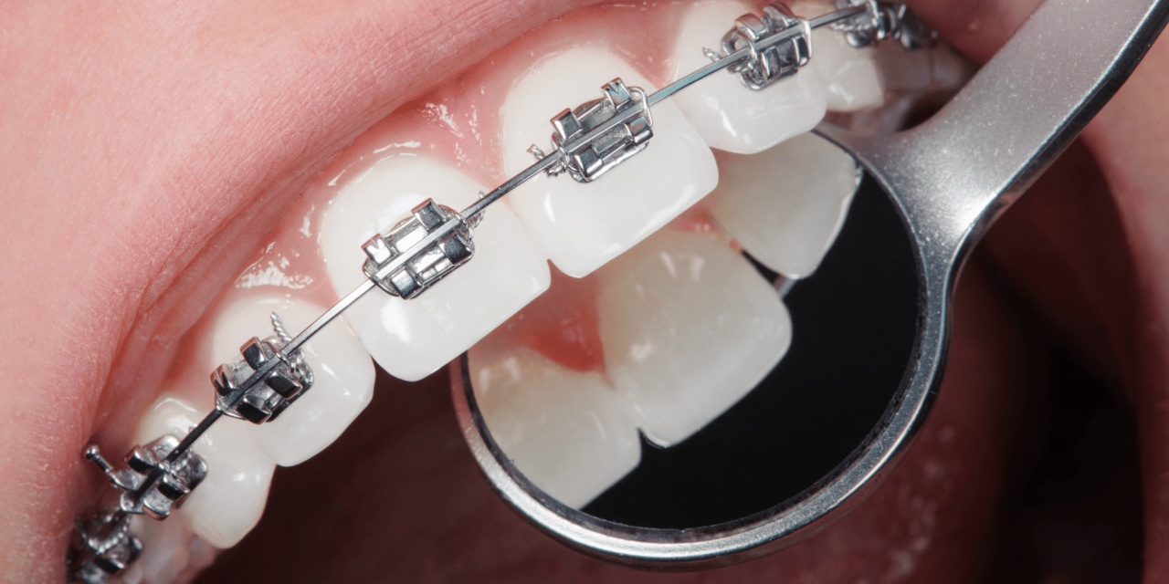 From Consultation to Retainers: Your Complete Orthodontic Journey in Adelaide